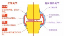 健康骨关节 “益”起动起来 社医联合为健康护航